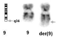 Development of BCR/ABL translocation probes To the centromere q34 region To the telomere ASS gene ~65 kb ABL gene ~225 kb Chromosome 9 Exon 1b Exon 1a Exon 2 Exon 11 kb S-FISH ES-FISH D-FISH kb