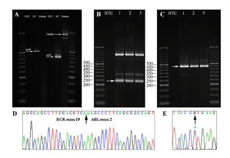 RT-PCR Multiplex PCR showing a band 234 bp RT-PCR targeting the e19a2 fusion transcript Automated sequencing confirming the e19a2 BCR-ABL