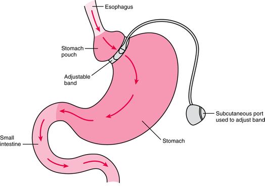 Introduction The placement of a gastric band has been shown to help people lose weight by making them feel full with smaller quantities of food.