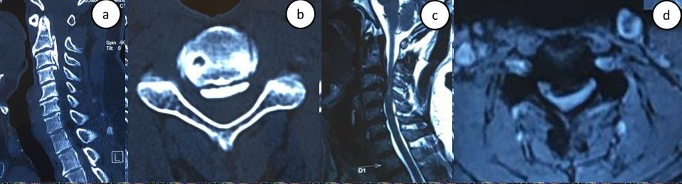 Shah et al www.ijsonline.co.in Figure. 1: a- preoperative MRI scan, b,c-preoperative CT scan, d-postoperative CT scan, e-postoperative MRI scan compromise.