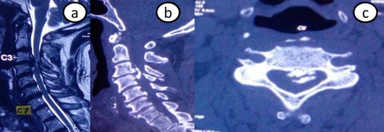 Figure 2 shows diffuse OPLL operated with posterior decompression and lateral mass fixation.
