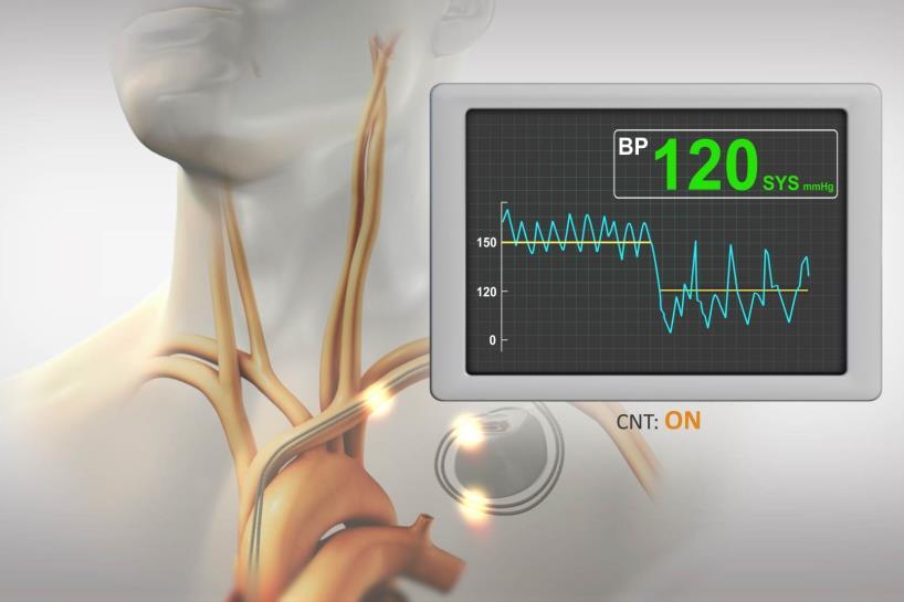 BackBeat Cardiac Neuromodulation Therapy (CNT) Overview Bioelectronic therapy that immediately, substantially and chronically lowers blood pressure (BP) while simultaneously modulating Autonomic