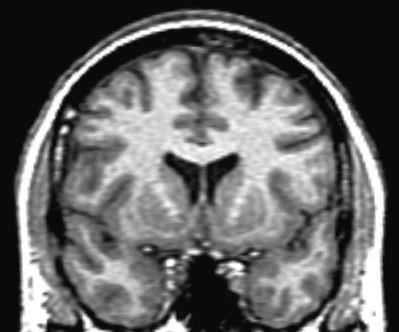 Unaffected Person with HD Huntington s Disease: What is it?