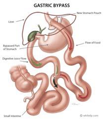 Roux-en en-y Y Gastric Bypass Restrictive and malabsorptive