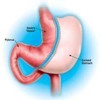 Sleeve Gastrectomy Restrictive, +/-hormonal Originally stage 1 of a 2 stage operation Technically straightforward Safety profile similar to bypass Gastric