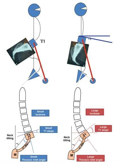 Cervical spinal alignment -Parameters Neck tilt Thoracic inlet angle (TIA) T1 slope TIA = T1 slope + neck tilt Cervical lordosis depends on T1 slope Similar to pelvic