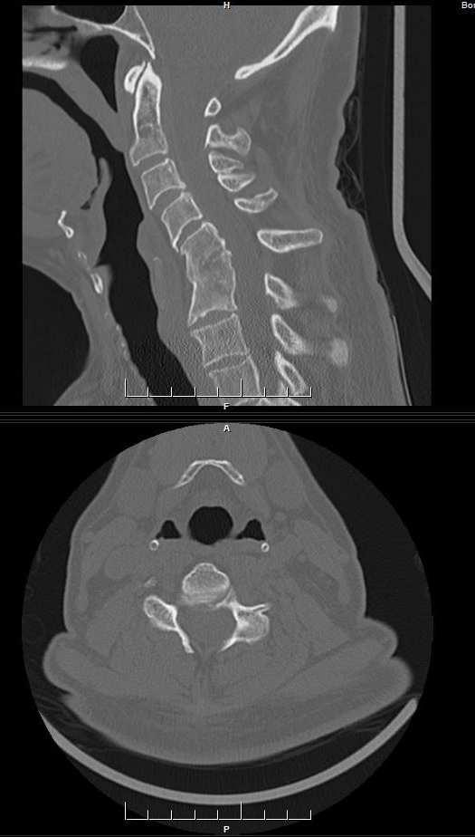 Pre-operative serial axial CT-scans of cervical