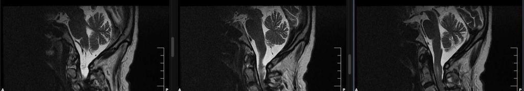 * Pre-operative sagital T2 MRI-scan of cervical spine *Signs of old C6