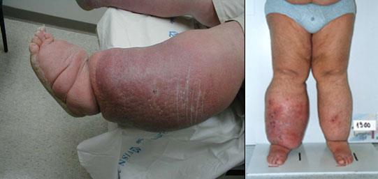 Cellulitis Infections a constant threat