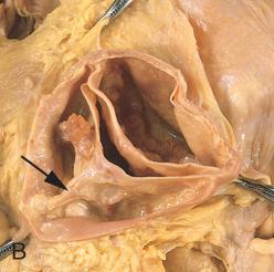Aortic Stenosis: Pathology XO Raphe Dystrophic calcification