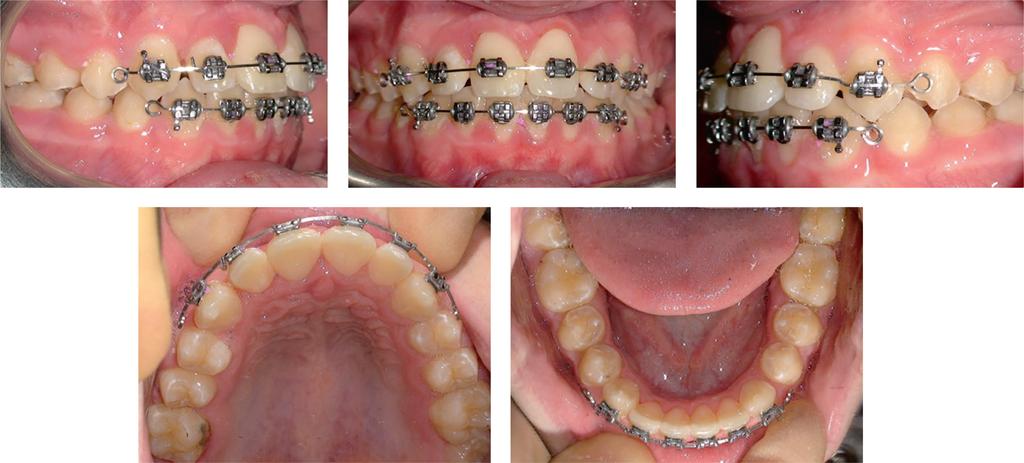 Management of three impacted teeth