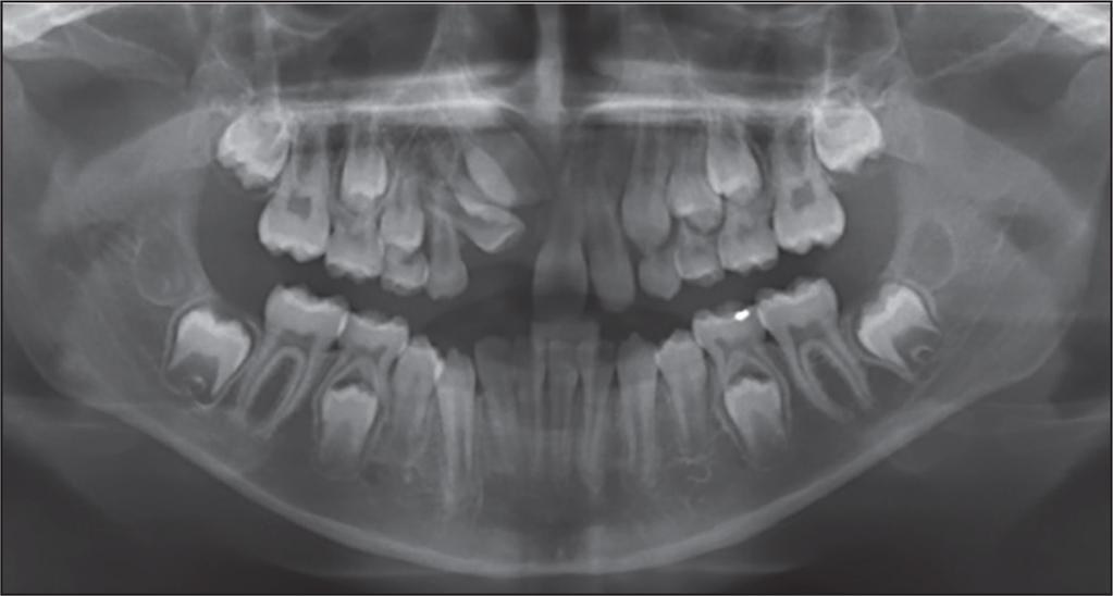 Management of three impacted teeth detected early