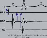 Normal sinus rhythm: Rate 60 100 /min P before every QRS QRS after every P All P are the