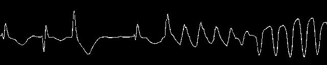 abnormal heart rhythm, which the change in the speed and the