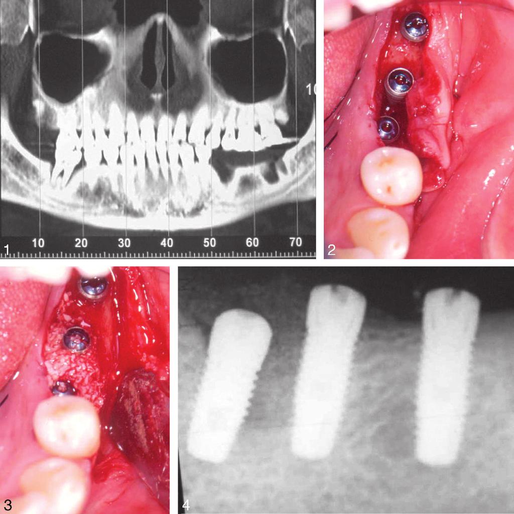 Ridge Augmentation and Implant Installation FIGURES 1 4. FIGURE 1. Preoperative panoramic view of the computerized tomography scan. FIGURE 2. The occlusal view after installation of 3 implants.