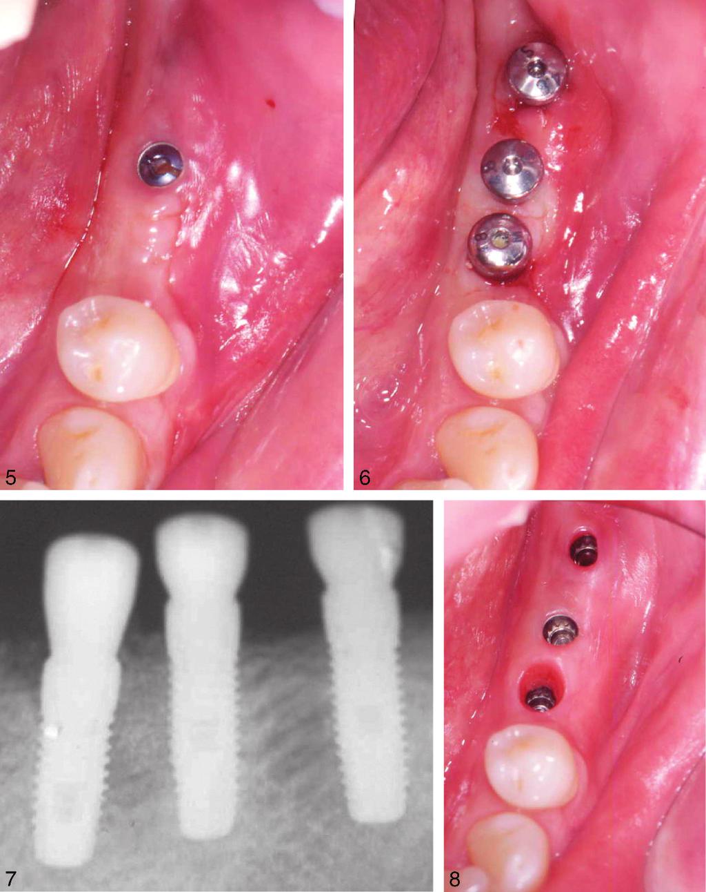 Park FIGURES 5 8. FIGURE 5. The occlusal view showing the exposure of the cover screw. FIGURE 6. Clinical view after connection of the healing abutments. FIGURE 7.