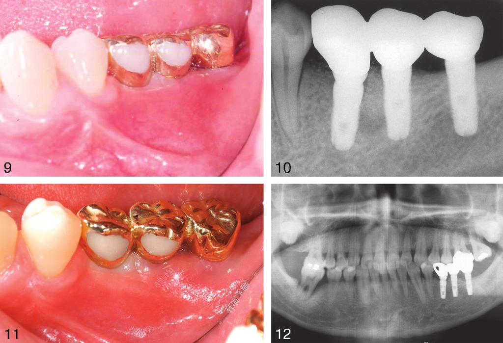 Ridge Augmentation and Implant Installation FIGURES 9 12. FIGURE 9. The prosthesis was delivered. FIGURE 10. No resorption around the implants was seen. FIGURE 11.