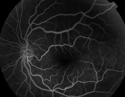 Figure 2c also shows increased hyperfluorescence in the overlying area of retinal detachment.