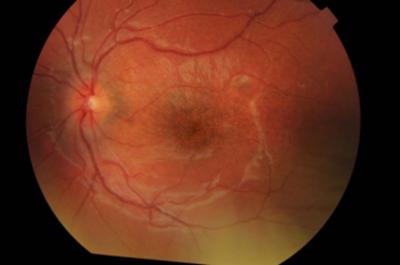 resolution of the retinal detachment, pigment deposition at the macula and a small area of residual inflammation temporal to the fovea (figure 3a).