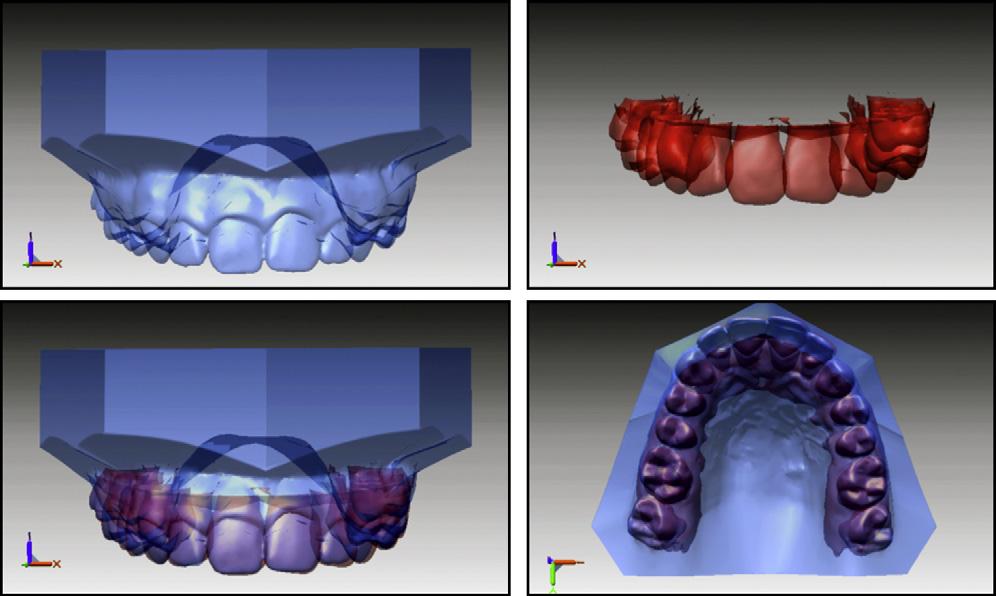 Lightheart et al 687 Fig 1. Superimposition of OrthoCAD and CBCT-generated models. roots of teeth, temporomandibular joint structures, impacted teeth, and bone levels are all visible.