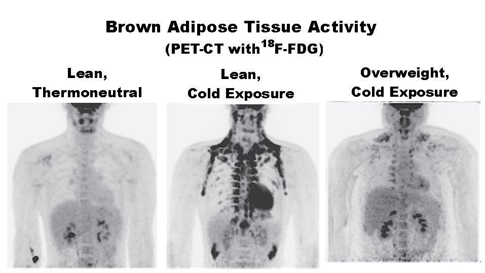 Older subjects and those with a higher BMI, have less brown adipose tissue.