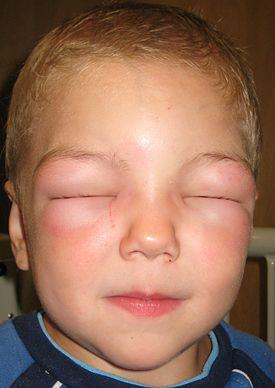 Mild to moderate symptoms of food allergy include: Swelling of face, lips and/or eyes Hives or welts on the skin