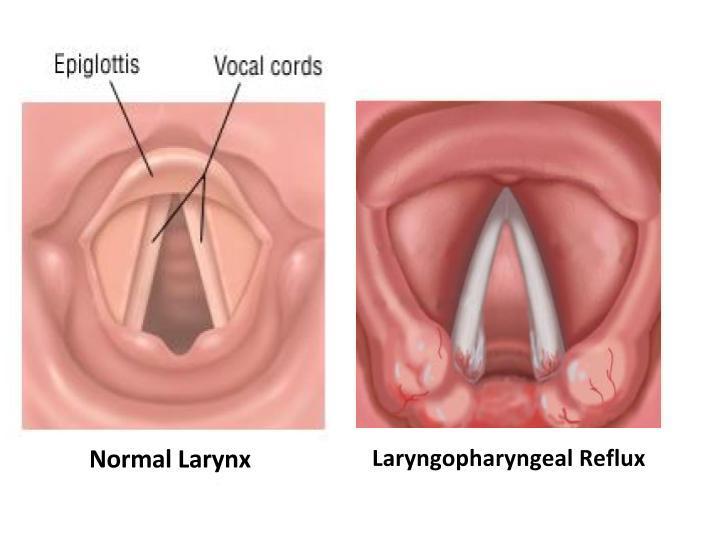 redness and swelling, with increased number of small capillaries. There is also increased the amount of mucus seen in the larynx. Fig.