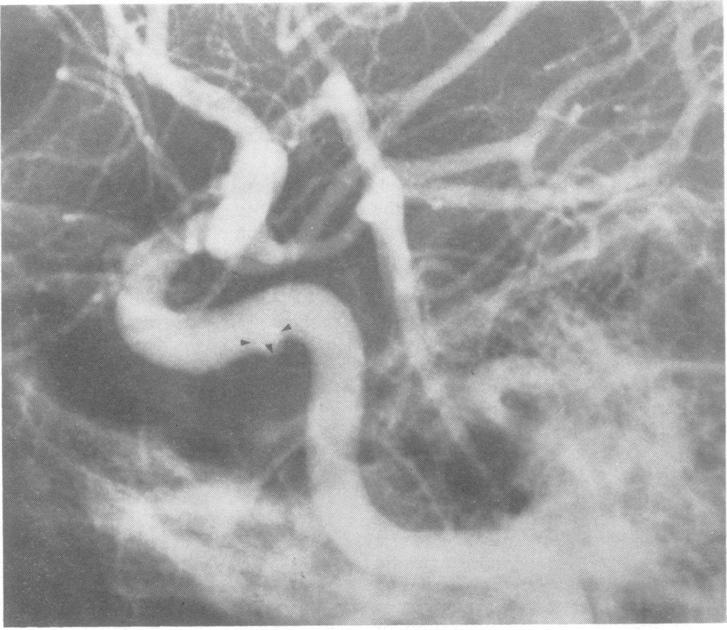 cavernous segment of internal carotid artery. ~.;............ Fig. Case.3.Left.