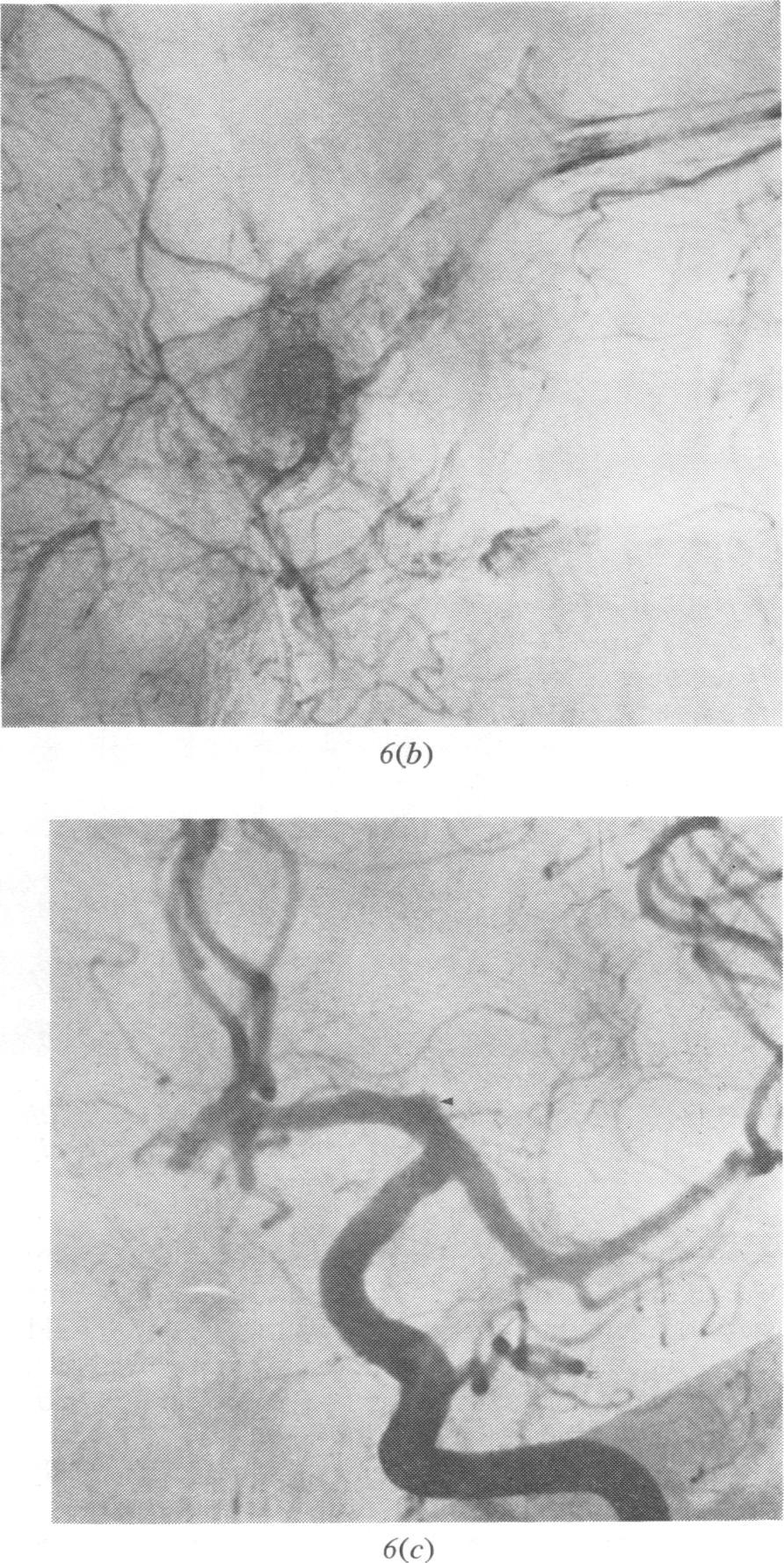 There is an unilocular aneurysm projecting superiorly and medially from the supraclinoid carotid, at the origin of the ophthalmic artery. f(i{ (a... Fig. 6 Case 6.