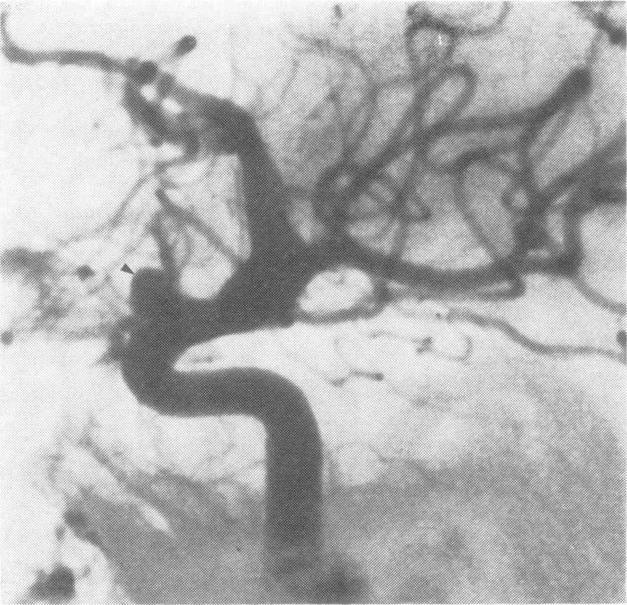 978 Jan Jakubowski and Brian Kendall Fig. 7 Case 7. Right internal carotid angiogram subtraction print lateral projection. Distal carotid aneurysm projecting anteriorly and superiorly (arrow head).