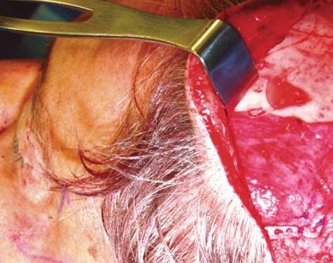 Intraoperative view showing an Endotine eyebrow suspension device (Coapt Systems, Palo Alto, California) placed during a coronal eyebrow-lift.
