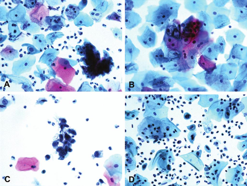 Figure 4. Representative photomicrographs of Papanicolaou tests in women with various human papilloma virus (HPV) infection patterns.