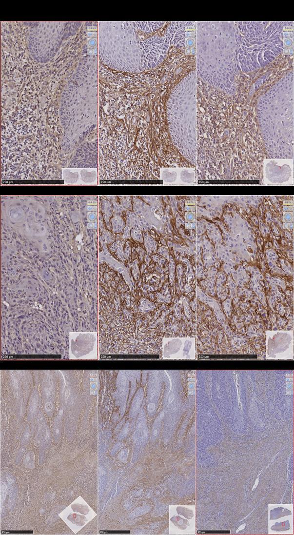 Supplementary Figure 10 Comparison of periostin, TGFBI and FN staining in HNSCC.