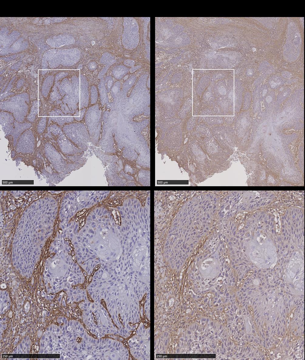 Supplementary Figure 11 Comparison of periostin and TGFBI staining in HNSCC. Immunohistochemical staining of periostin (left) and TGFBI (right) in a representative whole tumour section.
