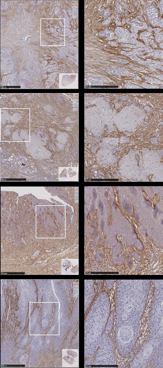 Supplementary Figure 9 Representative TGFBI staining in whole sections of HNSCC. Immunohistochemical staining of TGFBI in whole sections from 4 tumours.