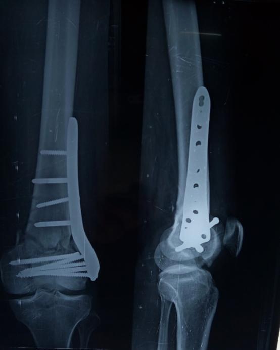 The literature review shows various different implants and techniques in the management of these fractures, the use of these devices