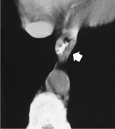 Panel B shows concentric esophageal-wall thickening (arrow)