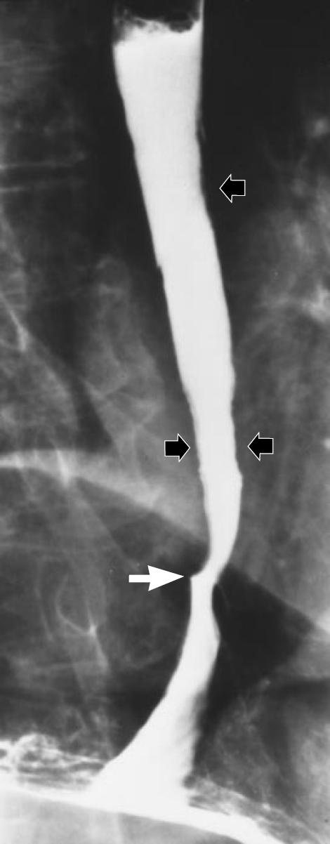 The irregularity of the mucosa is consistent with esophagitis (black arrows).