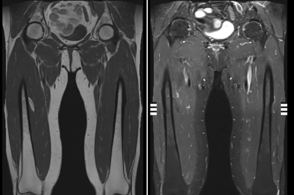 Bilateral incomplete AFFs on MRI showing focal