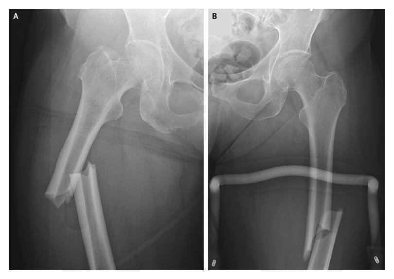 Atypical Fractures of the Femoral Diaphysis in Postmenopausal