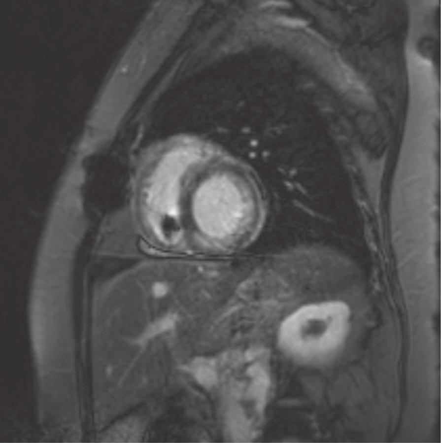 MRI-conditional pacing system despite position constraints. Figure 3 Late gadolinium enhancement images demonstrating enhancement in the inferior and lateral walls.