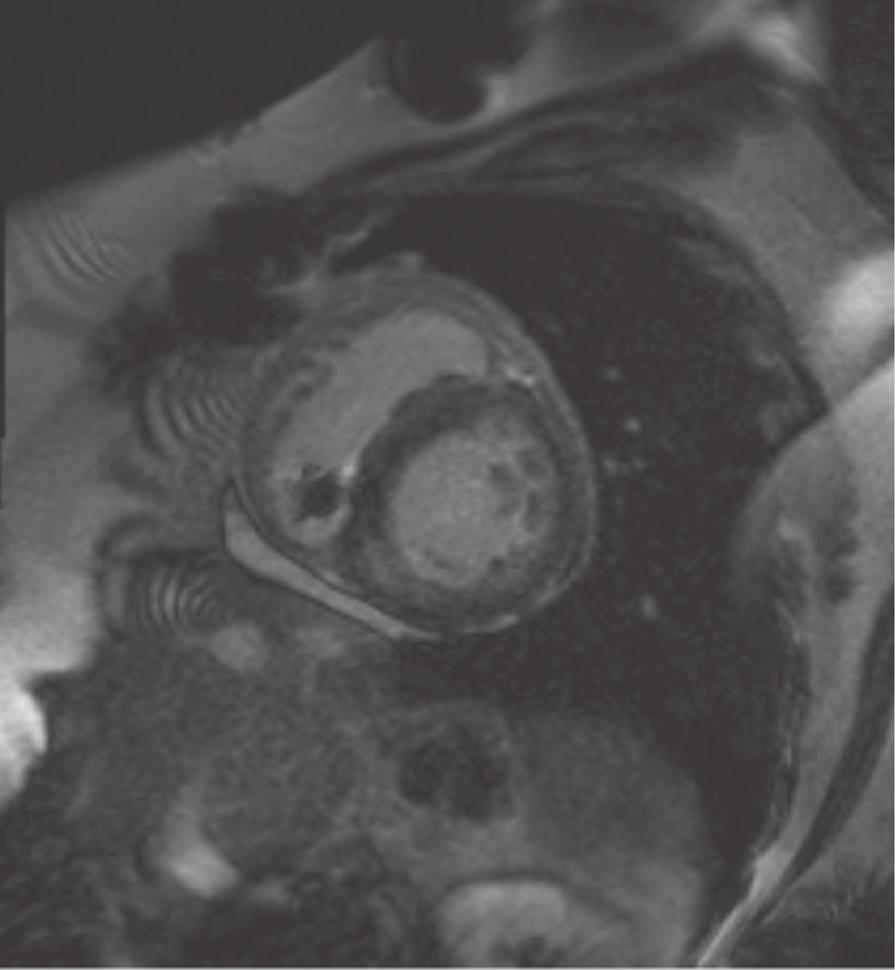 Case presentation A 34-year-old woman had a history of an anterior myocardial infarction following spontaneous left anterior descending coronary artery dissection 11 days postpartum at age 28