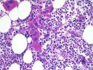 5 cm) age matched cellularity ** according to WHO grading $$ WHO definition of a megakaryocyte cluster: 3 or more megakaryocytes lying strictly adjacent - without other hematopoietic cells lying in