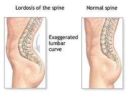 Again, there are many causes, but the most significant structural condition is excessive extension or hollow back (lordosis) of the lumbar (or low back) area of the