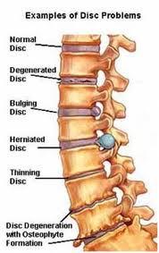 Herniation or bulging discs that separate the body of one vertebrae from