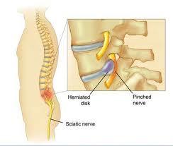 Certain degenerative conditions such as spondylothseis or spondylolisthesis may