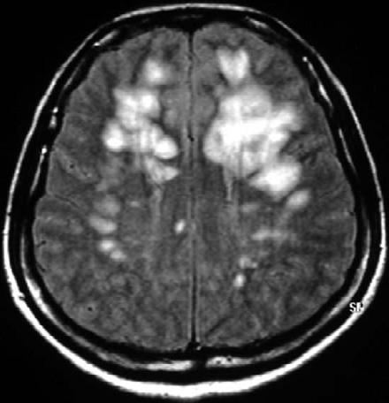 (B) Follow-up MRI shows aggravated brain swelling and extension of the brain lesions. A A2 B B2 uncontrolled ICP. We demonstrate the clinical condition as well as CA status with the PRx.