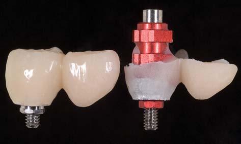 Impression caps were positioned to allow the registration of the implant shoulders, and appropriate positioning cylinders were then placed without incident.