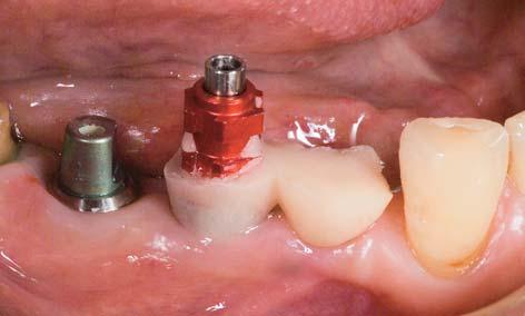 The screw-retained provisional restoration was fabricated in acrylic resin incorporating titanium provisional cylinders bridges, and it was delivered 8 weeks after