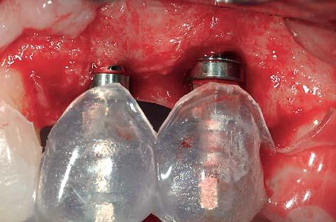 tissue augmentation procedures (Figs 5 10). The replacement of adjacent missing teeth in the anterior maxilla presents a far greater challenge (Table 4).